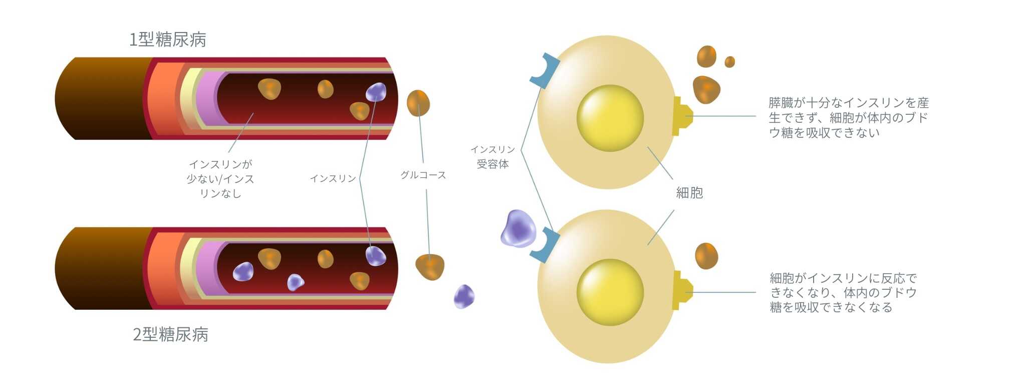 糖尿病の種類