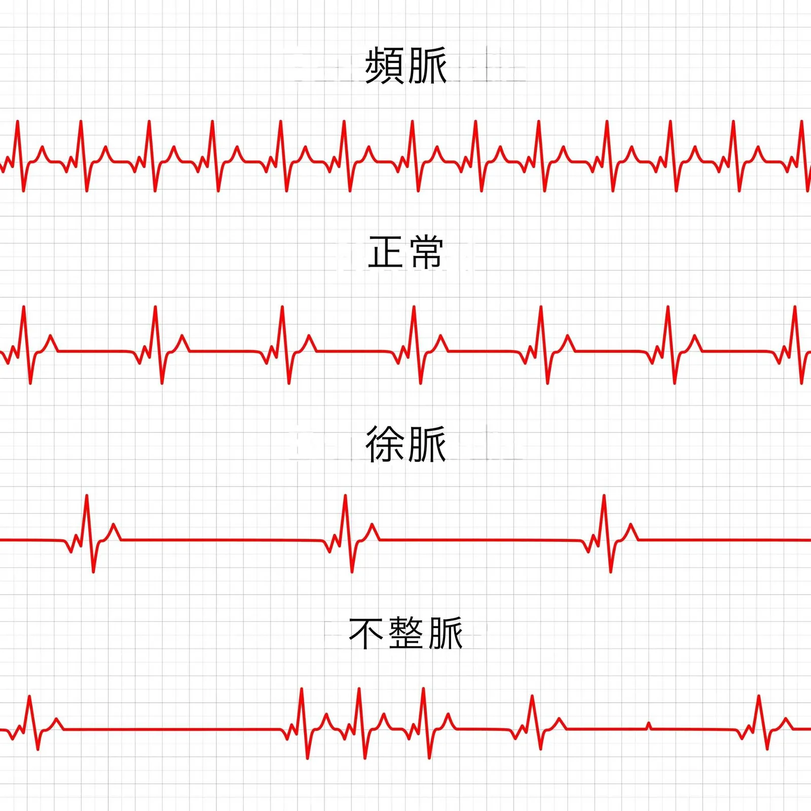 不整脈の種類