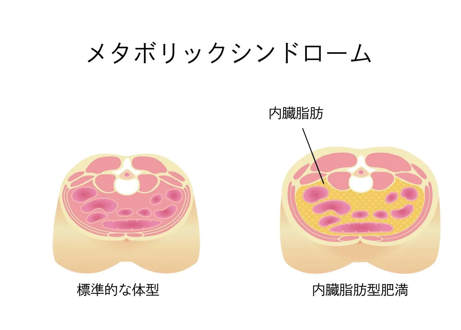 メタボリックシンドロームとはどのような状態か