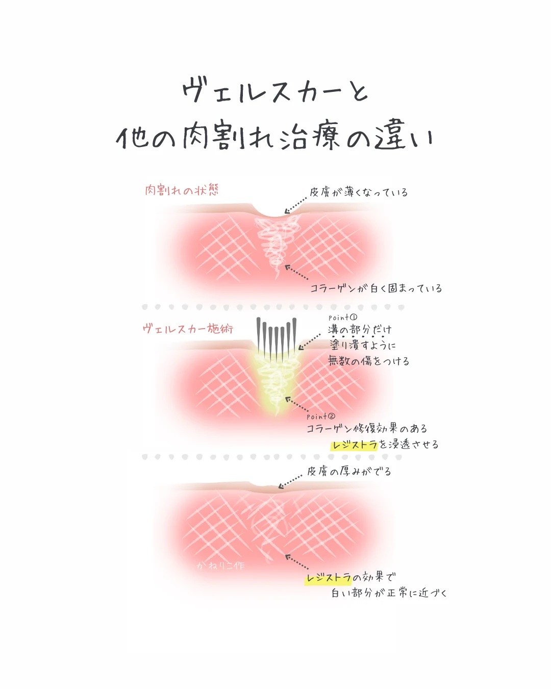 ヴェルスカーとは